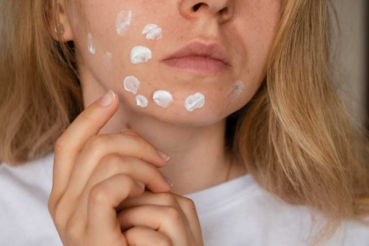 Acne Fixes That Actually Calm Things Down